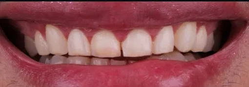 Antes: dentes com formato irregular e cor amarelada