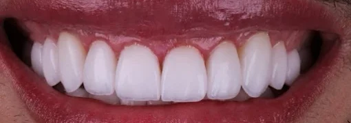 Sorriso após tratamento com lentes em porcelana, dentes alinhados e claros